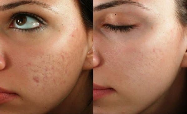 От чего появляются рубцы на коже лица