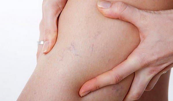 Сосудистые звездочки_причины появления
