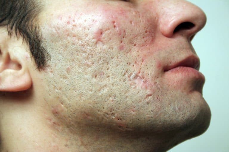 Что такое рубцевание кожи лица