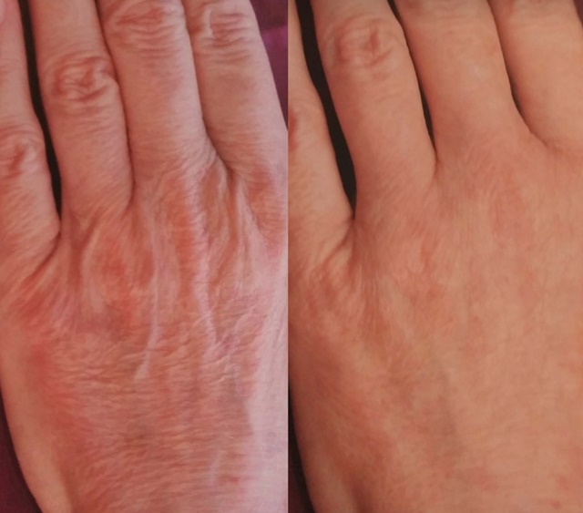 Эффект лазерной биоревитализации рук