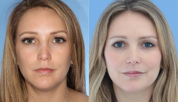 Моделирование овала лица_фото до и после