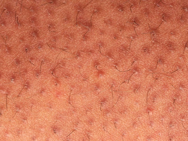 Уход за кожей после лазерной эпиляции области голеней