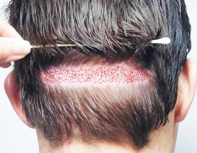 Хирургическое лечение, или трансплантация волос