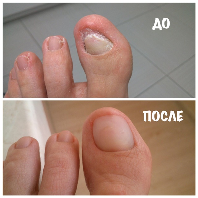 Протезирование ногтя акрилом (акрилатом)