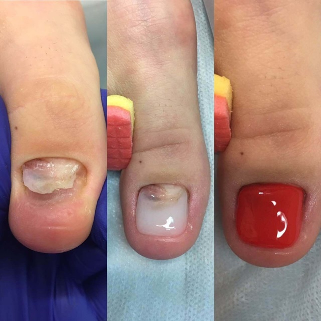 Необходимость в протезировании ногтя на руке или ноге
