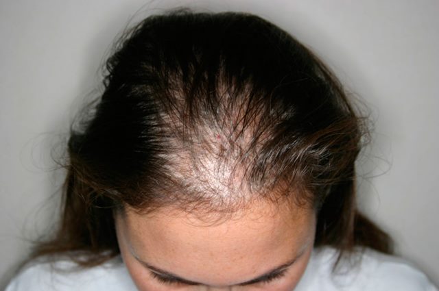 Симптомы паталогического выпадения волос после коронавируса